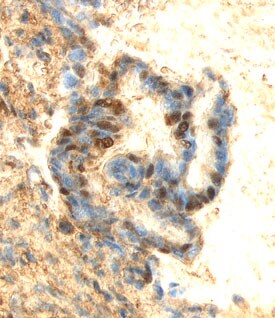 ERK3 antibody in Human Breast Cancer Tissue by Immunohistochemistry (IHC-P).