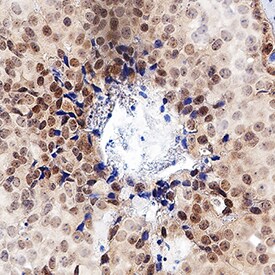 ERa/NR3A1 antibody in Human Breast Cancer Tissue by Immunohistochemistry (IHC-P).