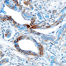 Endophilin B1/Bif-1 antibody in Human Pancreatic Cancer Tissue by Immunohistochemistry (IHC-P).