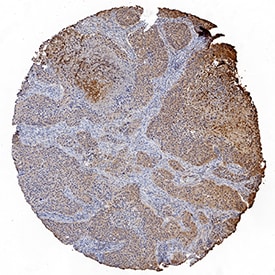 Ephrin-A4 antibody in Human Squamous Cell Carcinoma by Immunohistochemistry (IHC-P).