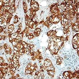 ErbB2/Her2 antibody in Human Breast Cancer Tissue by Immunohistochemistry (IHC-P).