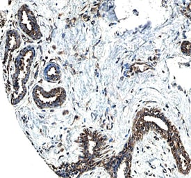 ErbB2/Her2 antibody in Human Breast Cancer Tissue by Immunohistochemistry (IHC-P).