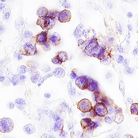 ErbB2/Her2 antibody in Human Breast Cancer Tissue by Immunohistochemistry (IHC-P).