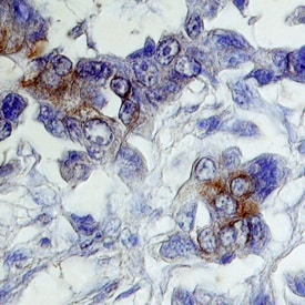 ErbB2/Her2 antibody in Human Breast Cancer Tissue by Immunohistochemistry (IHC-P).