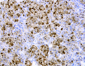 FABP7 antibody in Human Melanoma by Immunohistochemistry (IHC-P).