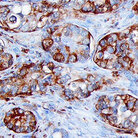 FBPase 1 antibody in Human Liver Cancer Tissue by Immunohistochemistry (IHC-P).