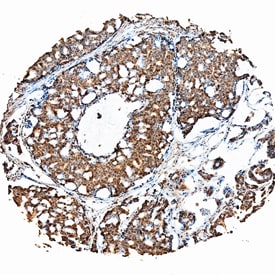 FGF-19 antibody in Human Prostate Cancer Tissue by Immunohistochemistry (IHC-P).