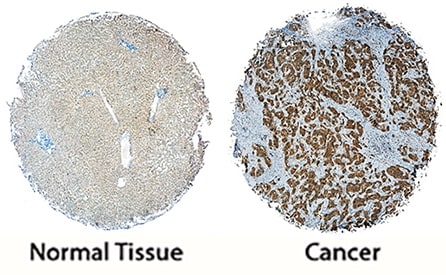 FRS2 antibody in Human Liver and Liver Cancer Tissue by Immunohistochemistry (IHC-P).