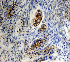 FSH R antibody in Human Ovarian Cancer Tissue by Immunohistochemistry (IHC-P).