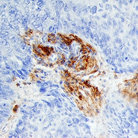 Fibroblast Activation Protein a/FAP antibody in Human Squamous Cell Carcinoma by Immunohistochemistry (IHC-P).