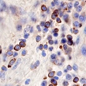 Frizzled-6 antibody in Human Kidney Cancer Tissue by Immunohistochemistry (IHC-P).