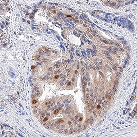 GAPDH antibody in Human Prostate Cancer Tissue by Immunohistochemistry (IHC-P).
