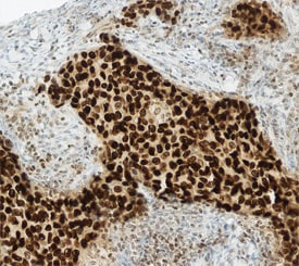 GATA-3 antibody in Human Breast Cancer Tissue by Immunohistochemistry (IHC-P).