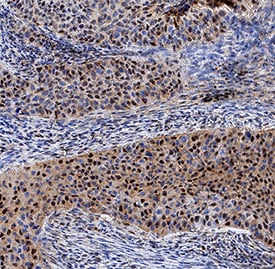 GLI-2 antibody in Human Squamous Cell Carcinoma by Immunohistochemistry (IHC-P).