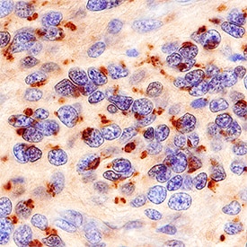 Golgi Glycoprotein 1/GLG1 antibody in Human Astrocytoma by Immunohistochemistry (IHC-P).