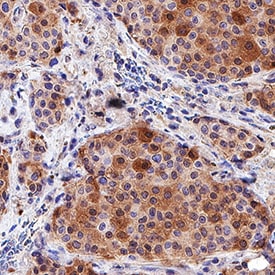 Gremlin antibody in Human Breast Cancer Tissue by Immunohistochemistry (IHC-P).