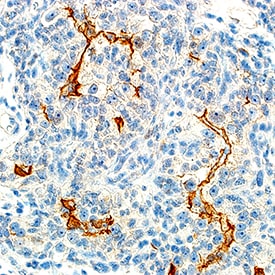HGF R/c-MET antibody in Human Renal Cell Carcinoma Tissue by Immunohistochemistry (IHC-P).