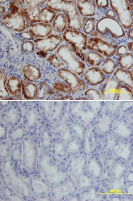 HIF-1 alpha/HIF1A antibody in Human Kidney Cancer Tissue by Immunohistochemistry (IHC-P).