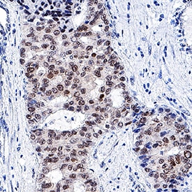 HNF-3 beta /FoxA2 antibody in Human Liver Cancer Tissue by Immunohistochemistry (IHC-P).