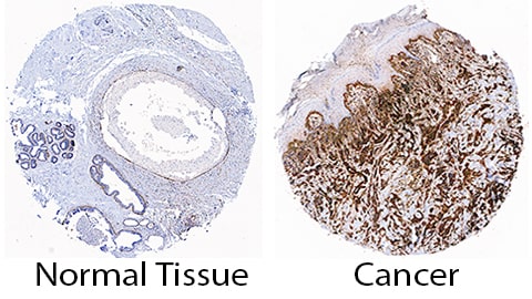HSP47 antibody in Human Breast Cancer Tissue by Immunohistochemistry (IHC-P).