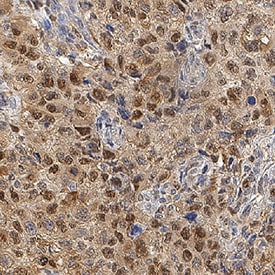 HSP70/HSPA1A antibody in Human Kidney Cancer Tissue by Immunohistochemistry (IHC-P).