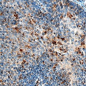 Hexokinase 1/2 antibody in Human Cervical Cancer Tissue by Immunohistochemistry (IHC-P).