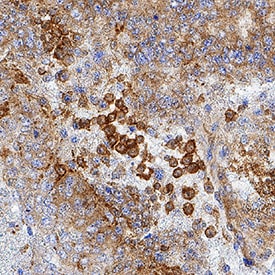 IFN-epsilon antibody in Human Endometrial Cancer Tissue by Immunohistochemistry (IHC-P).