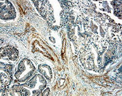 IL‑15 Ra antibody in Human Prostate Cancer Tissue by Immunohistochemistry (IHC-P).