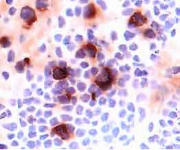 CD25/IL-2 Ra antibody in Human Lymph Node by Immunohistochemistry (IHC-Fr).