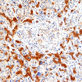 Detection of Alkaline Phosphatase in Human Liver Cancer.