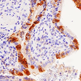 Detection of HAI-1 in Human Lung Cancer.