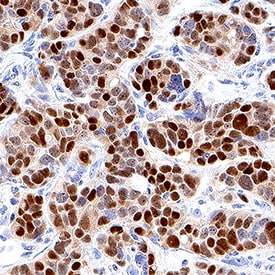 Detection of Progesterone R/NR3C3 in Human Breast Cancer Tissue.
