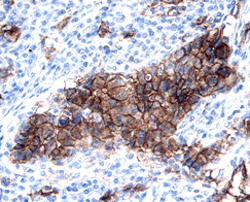 Kallikrein 6/Neurosin antibody in Human Breast Cancer Tissue by Immunohistochemistry (IHC-P).