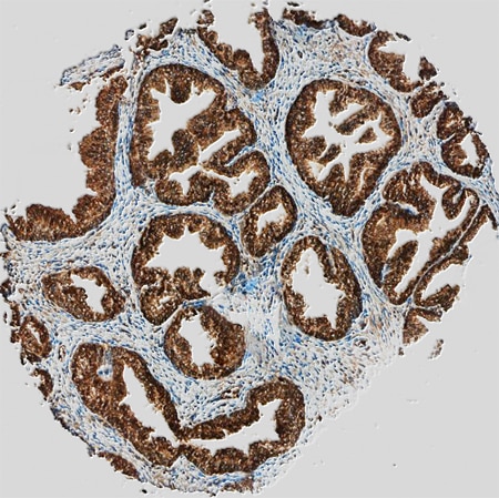 LAP (TGF-beta 1) antibody in Human Prostate Cancer Tissue by Immunohistochemistry (IHC-P).