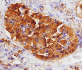 LH beta  antibody in Human Pituitary Adenoma by Immunohistochemistry (IHC-P).
