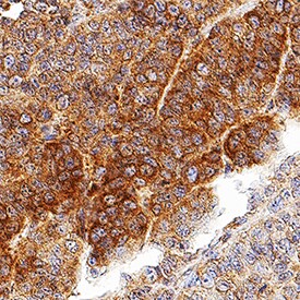 LRIG2 antibody in Human Squamous Cell Carcinoma by Immunohistochemistry (IHC-P).