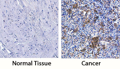 LRIG3 antibody in Human Cervical Cancer Tissue by Immunohistochemistry (IHC-P).