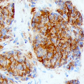 Ly6K antibody in Human Lung Cancer Tissue by Immunohistochemistry (IHC-P).