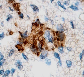 MMP‑13 antibody in Human Ovarian Cancer Tissue by Immunohistochemistry (IHC-P).