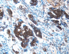 MMP‑13 antibody in Human Ovarian Cancer Tissue by Immunohistochemistry (IHC-P).