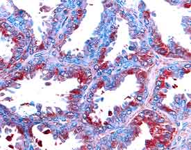 MMP‑14 antibody in Human Benign Nodular Hyperplasia by Immunohistochemistry (IHC-P).