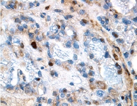 MMP-1 antibody in Human Ovarian Cancer Tissue by Immunohistochemistry (IHC-P).