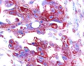 MMP‑1 antibody in Human Ovarian Cancer Tissue by Immunohistochemistry (IHC-P).