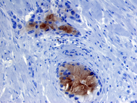 MMP‑7 antibody in Human Pancreatic Cancer Tissue by Immunohistochemistry (IHC-P).