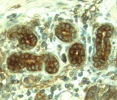MMP‑8 antibody in Human Breast Cancer Tissue by Immunohistochemistry (IHC-P).