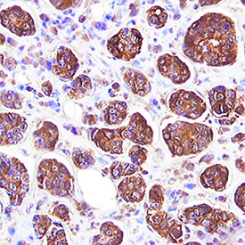 MMP-8 antibody in Human Breast Cancer Tissue by Immunohistochemistry (IHC-P).