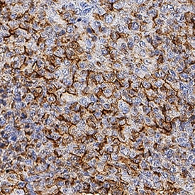 Melanotransferrin/CD228 antibody in Human Melanoma Tissue by Immunohistochemistry (IHC-Fr).