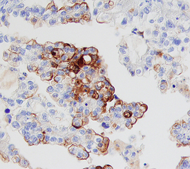 Mesothelin antibody in Human Ovarian Cancer Tissue by Immunohistochemistry (IHC-P).