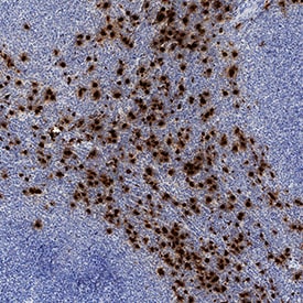 Neutrophil Elastase/ELA2 antibody in Human Lymphoma by Immunohistochemistry (IHC-P).