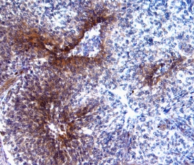 P-Selectin/CD62P antibody in Human Breast Cancer Tissue by Immunohistochemistry (IHC-P).